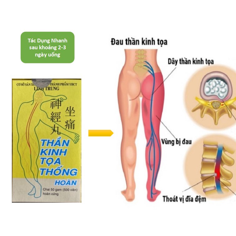 Hỗ trợ NGƯỜI BỊ đau dây thần kinh tọa-ĐAU LƯNG-MỎI GỐI-ĐAU NHỨC XƯƠNG KHỚP DO THOÁI HÓA
