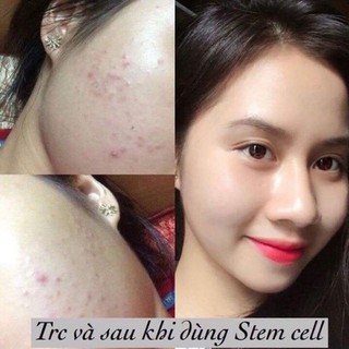 Kem xoá mụn thâm Stemcel xanh