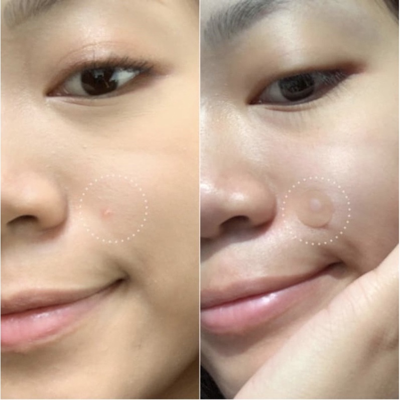 Dán mụn Hero Mighty Patch