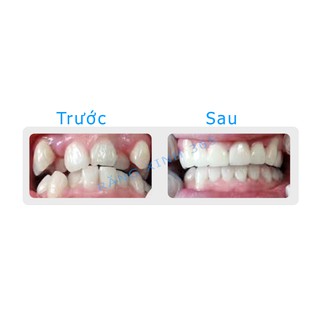 Niềng Răng Bí Mật ( Hàng Chính Hãng )