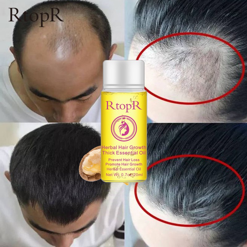 Tinh Dầu Dưỡng Tóc RtopR Kích Thích Mọc Tóc 20ml | BigBuy360 - bigbuy360.vn