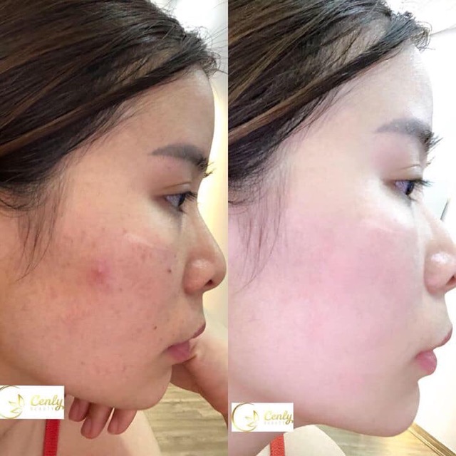 Serum Trị Mụn Amoli | BigBuy360 - bigbuy360.vn