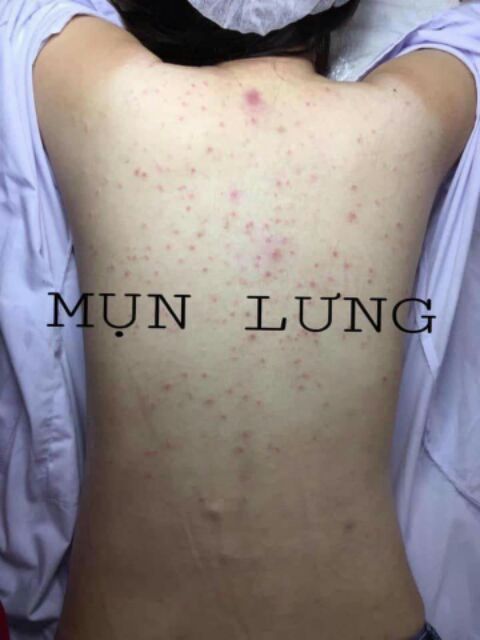 COMBO 2 CHAI MEN VI SINH TAVIDA HẾT MỤN LƯNG, VIÊM NANG LÔNG, MẨN NGỨA