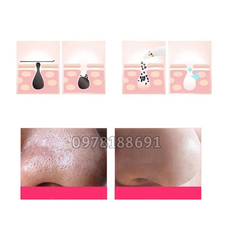 Máy Hút Mụn Cầm Tay Mini – Máy Hút Mụn Đầu Đen Nhanh Chóng, Se Khít Lỗ Chân Lông