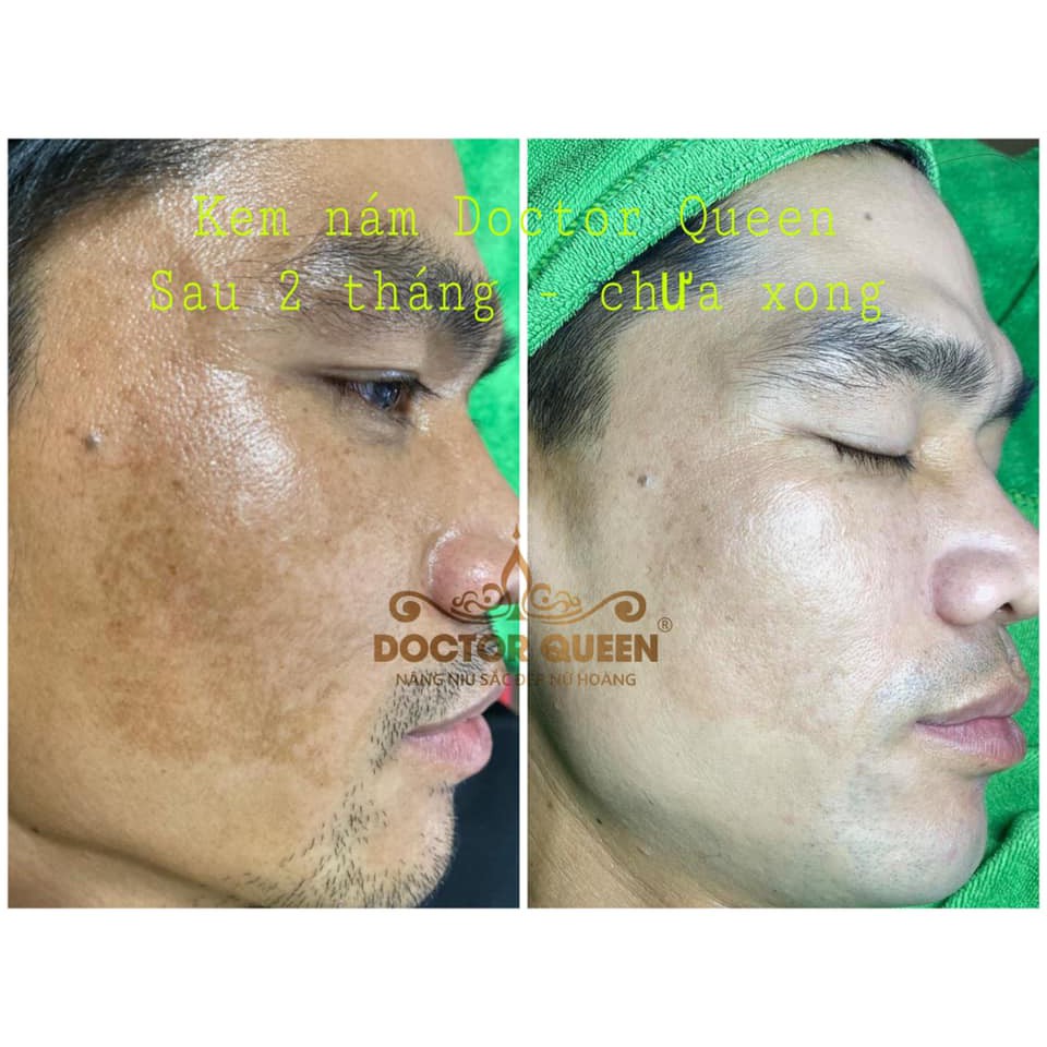 KEM NÁM DOCTOR QUEEN--