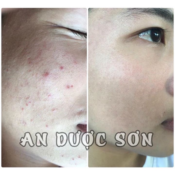 Serum tái tạo bong da An Dược Sơn 50ml