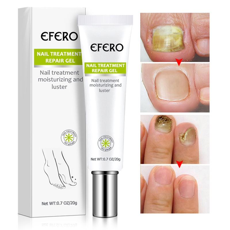 Efero Nấm móng tay Serum Tẩy tế bào chết Thực vật Sửa chữa móng tay Kem dạng lỏng Loại bỏ nấm chân Gel chống nhiễm trùng Paronychia Tinh chất điều trị nấm móng để chăm sóc móng