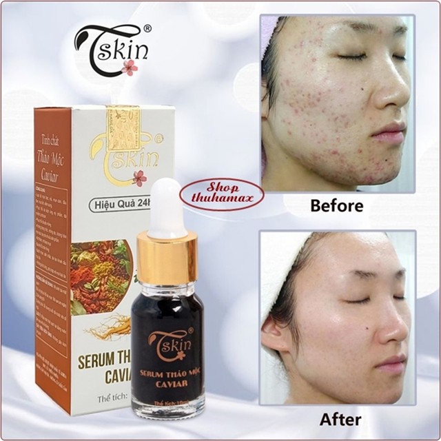 Serum Tskin Thảo Mộc Caviar