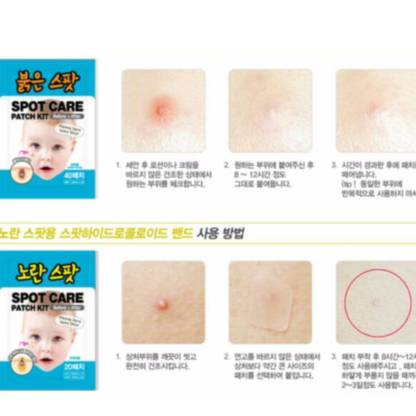 Miếng dán  mụn Hàn Quốc Haley cải tiến 20-40-80 miếng