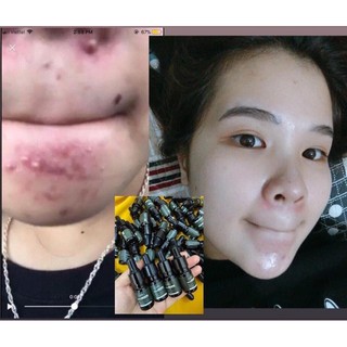 Tinh chất mướp đắng Lim