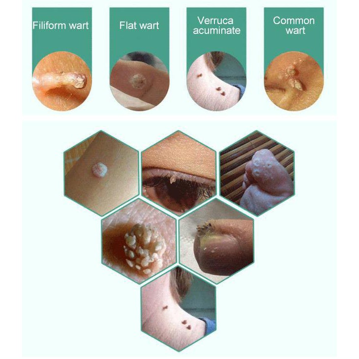 (Hàng Mới Về) Dung Dịch Trị Mụn Cóc Hiệu Quả