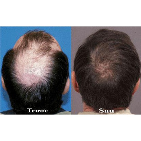 Xịt tóc thảo mộc kích thích mọc tóc, chăm sóc da đầu, chống rụng, chống hói đầu SE Compliment