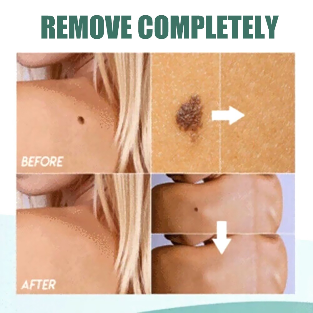 Dung dịch loại bỏ Mole hiệu quả cho da mặt 20ml | BigBuy360 - bigbuy360.vn