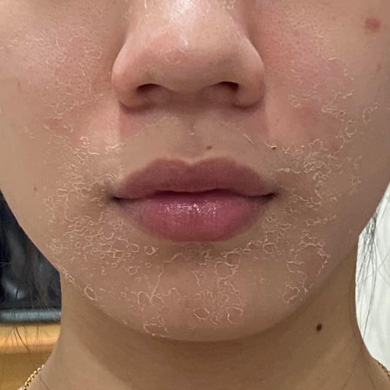 Tinh chất thay da sinh học NeoStrata ProSystem Retinol Peel 1.5ml