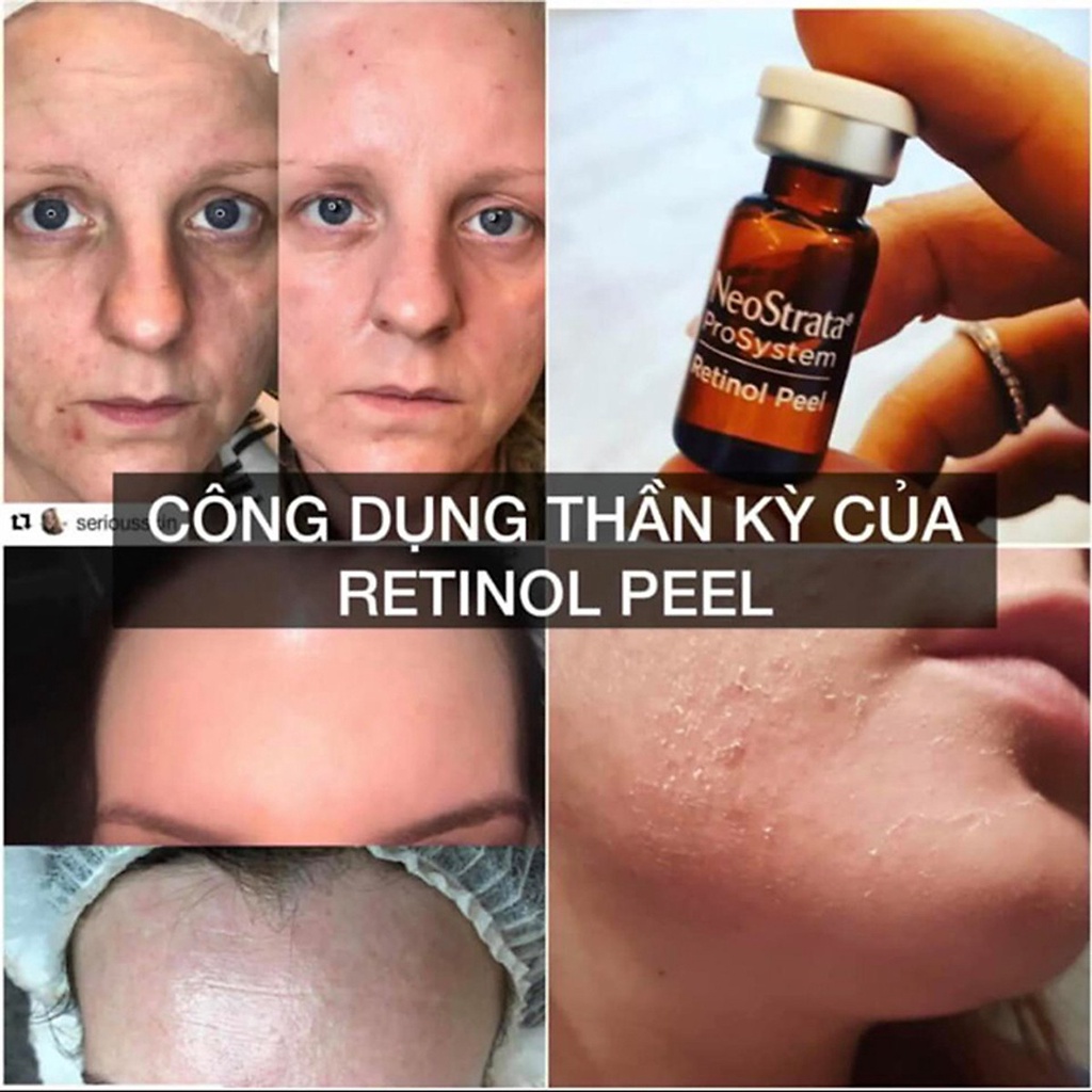 Peel da sinh học NeoStrata prosystem retinol peel 1.5ml