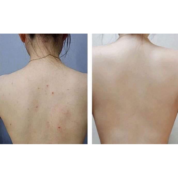 Sữa tắm tẩy tế bào chết và giảm mụn lưng Neutrogena Body Clear 250ml date 9/2023 - EDS Hàng Mỹ