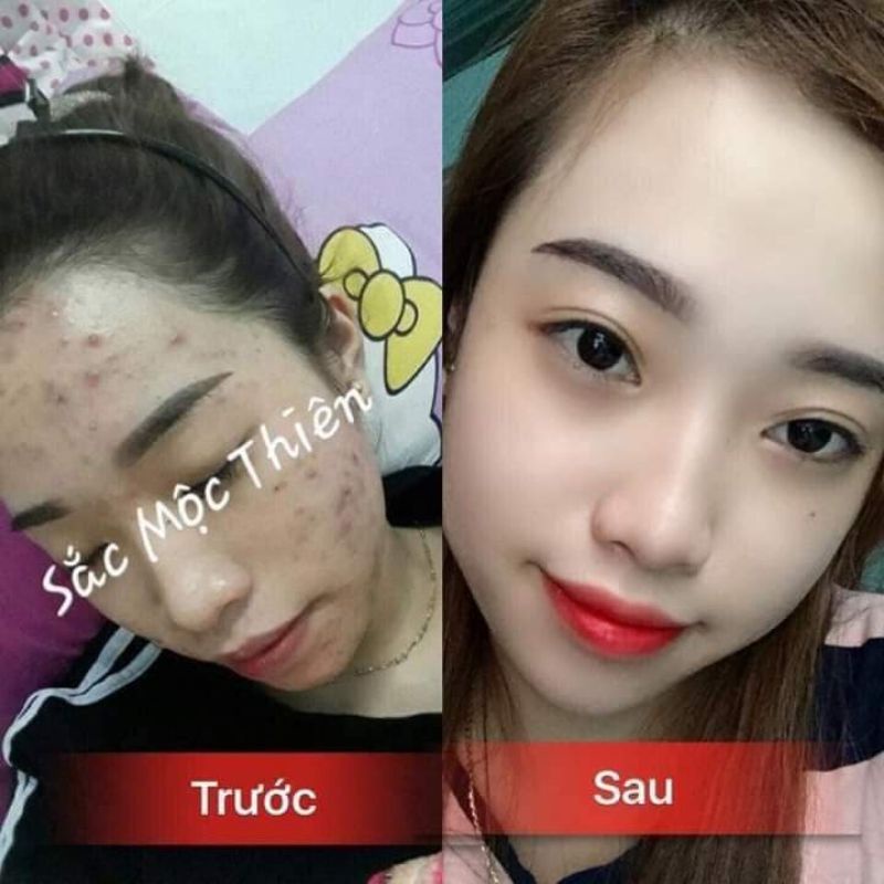 Tái tạo da cao cấp Sắc Mộc Thiên- Hỗ trợ cải thiện mụn- Nám- Tàn nhang- Sẹo | BigBuy360 - bigbuy360.vn