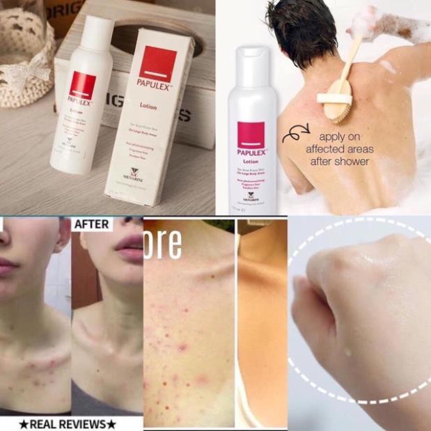 [NHẬP KHẨU] Sữa Dưỡng Mụn Toàn Thân, Mụn Lưng, Mụn Vai, Mụn Ngực, Cổ - Papulex Lotion (125ml)