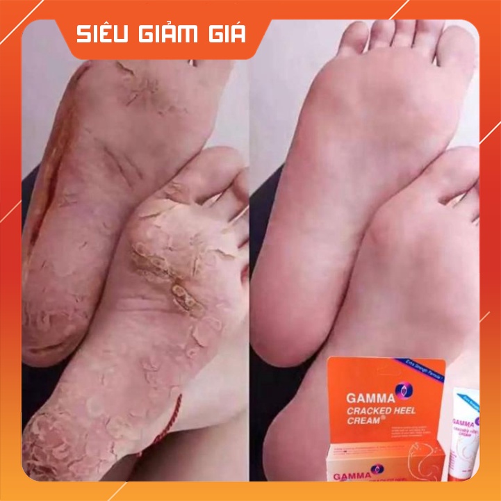 Kem giảm nứt gót chân, khô nứt da Gamma Cracked Heel sản phẩm chuyên dùng cho da khô nứt nẻ cho kết quả cực kỳ tốt. ...
