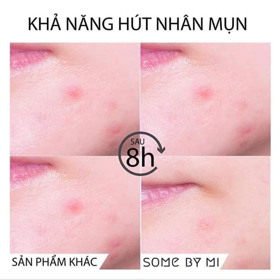 Miếng dán mụn thần tốc Some by mi clear spot patch 18 miếng