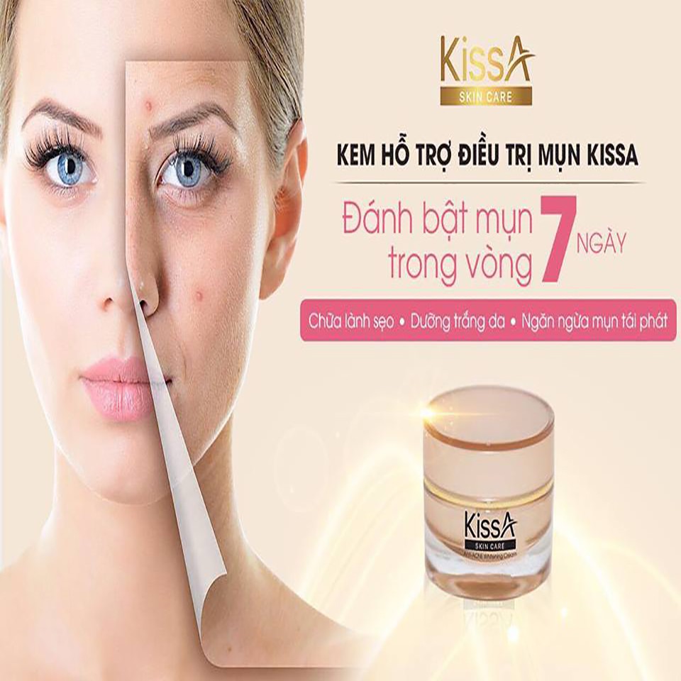 Kem Hỗ Trợ Điều Trị Mụn KissA