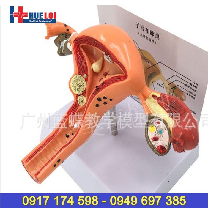 Mô hình giải phẫu bệnh lý hệ sinh dục nữ
