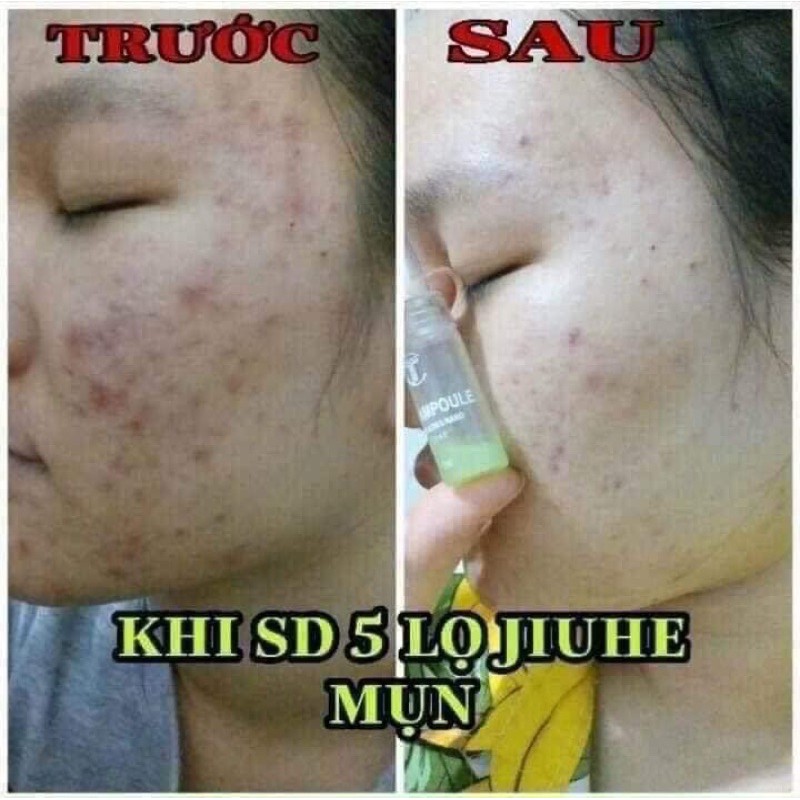 SERUM JIUHE ACNES NANO MỤN THANH TÔ CHÍNH HÃNG 100%