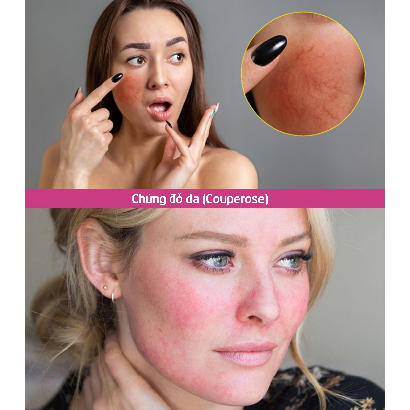 CANOVA Sensiven P22 50mL - Kem Làm Dịu Da, Dưỡng Ẩm Dành Cho Da Nhạy Cảm.