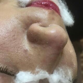 CẶP Ủ MỤN ĐẦU ĐEN