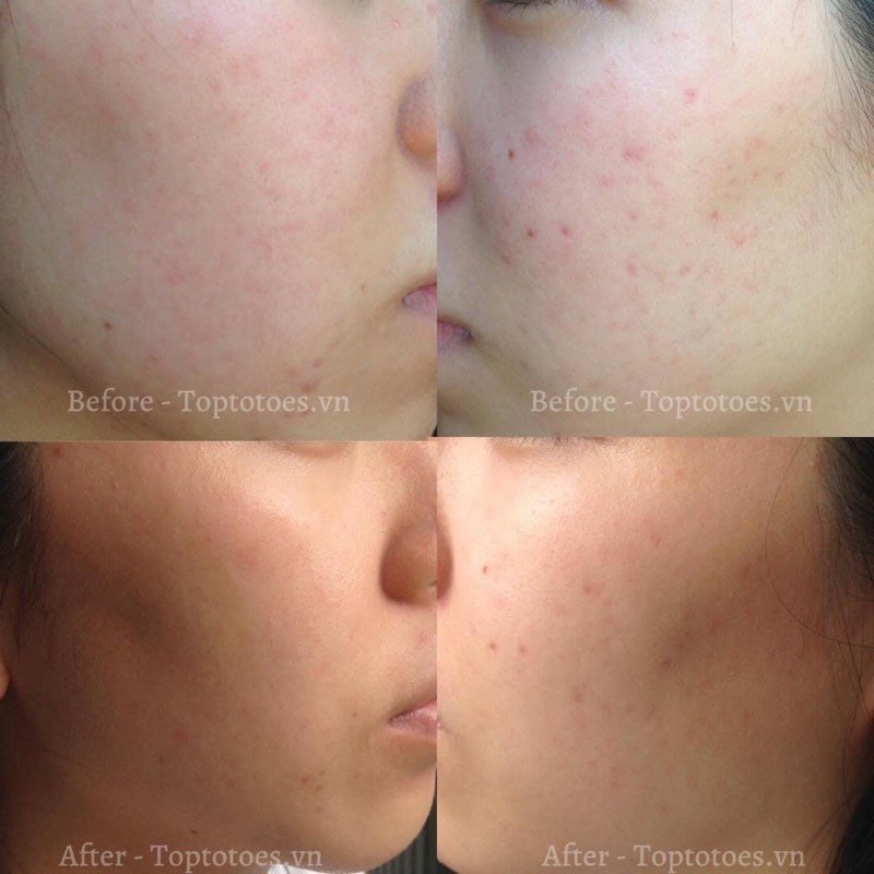 Serum Teana Super Peptides ASAP dưỡng trắng, mờ thâm, cải thiện kết cấu da