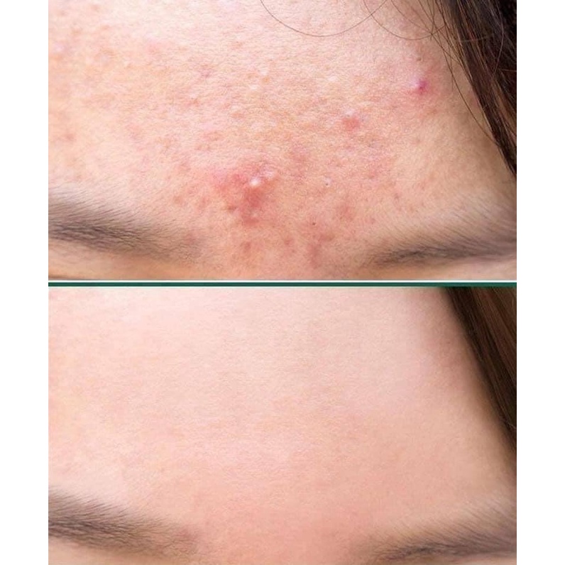Serum Giảm Thâm , Hỗ trợ Trị Mụn The Ordinary Niacinamide 10% + Zinc 1%