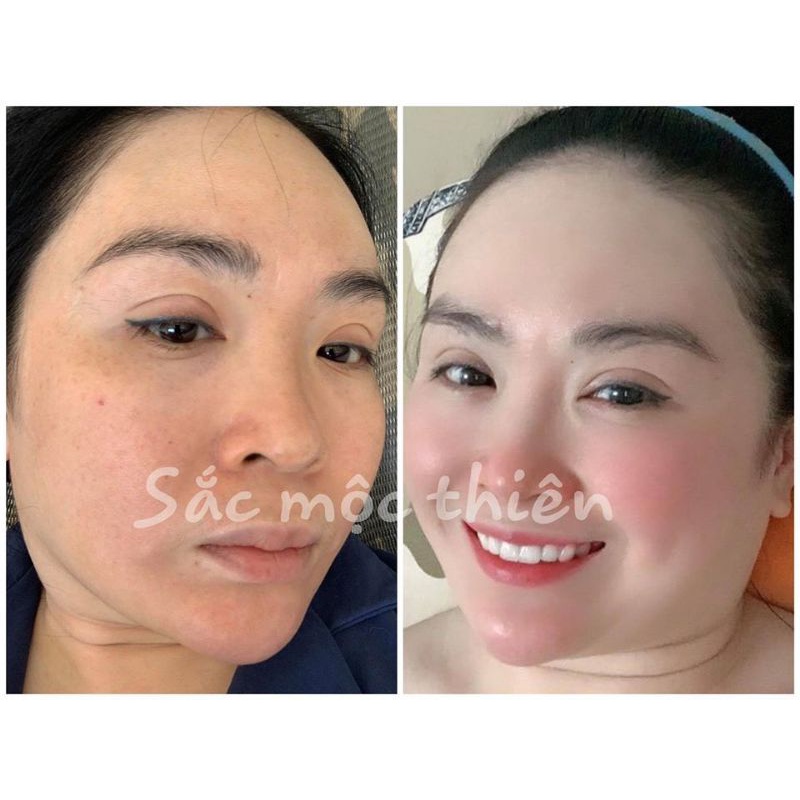 Tái tạo da cao cấp Sắc Mộc Thiên- Hỗ trợ cải thiện mụn- Nám- Tàn nhang- Sẹo | BigBuy360 - bigbuy360.vn