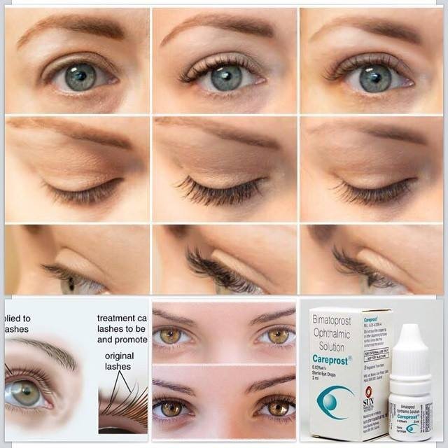 Thuốc mọc mi Dưỡng Và Hỗ Trợ Mọc Mi Cong, Mày Dài Và Dày Careprost Eyelashes Ấn Độ