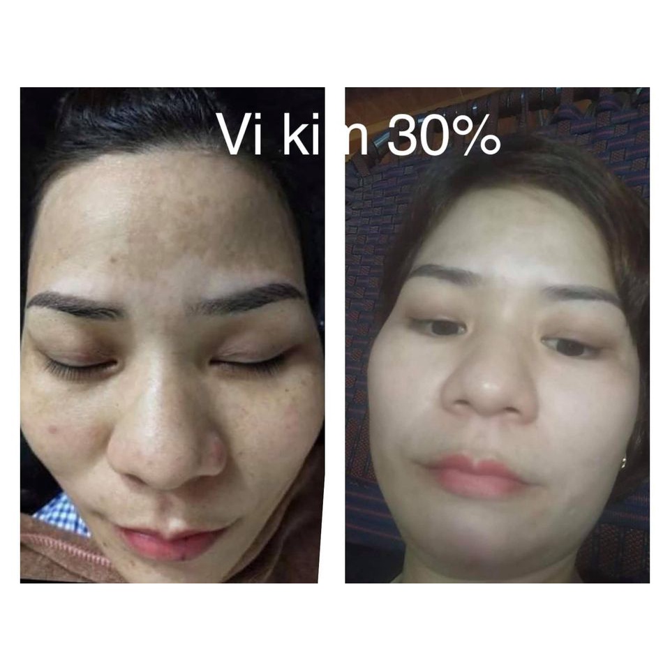 Combo vi kim cá nhân Set 1 mặt nạ tế bào gốc IDENEL 25ml + 1 vi kim 30% IDENEL 1gr - đưa dưỡng chất vào đáy lớp biểu bì