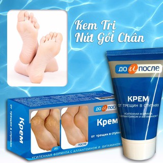 KEM DƯỠNG TRỊ NỨT GÓT CHÂN KPEM