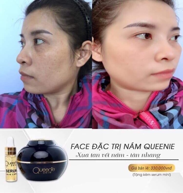 [TẶNG KÈM SERUM] KEM FACE NÁM TÀN NHANG QUEENIE SKIN | BigBuy360 - bigbuy360.vn