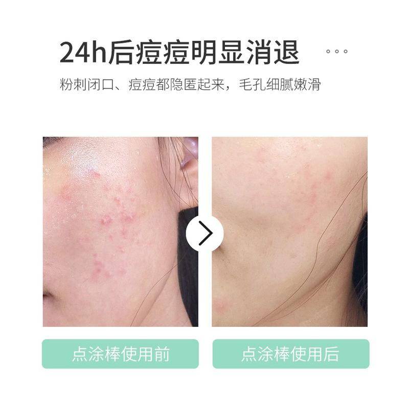 Hộp tăm bông cotton loại bỏ mụn trứng cá