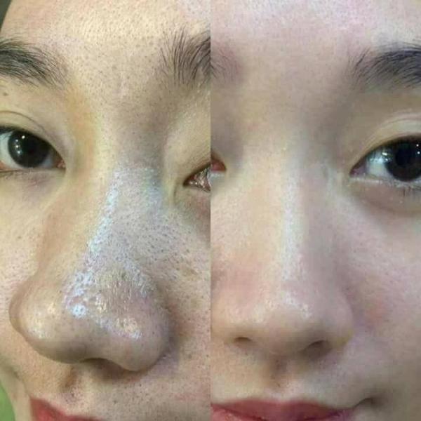 TINH CHẤT Ủ ĐẨY MỤN ĐẦU ĐEN OHIO HÀN QUỐC