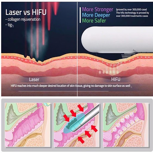 MÁY HIFU TIONRIC TRẺ HÓA, SE KHÍT ÂM ĐẠO CÔNG NGHÊ MỚI 2020 GIÁ TỐT NHẤT