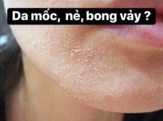 Vaseline viện bỏng Lê Hữu Trác