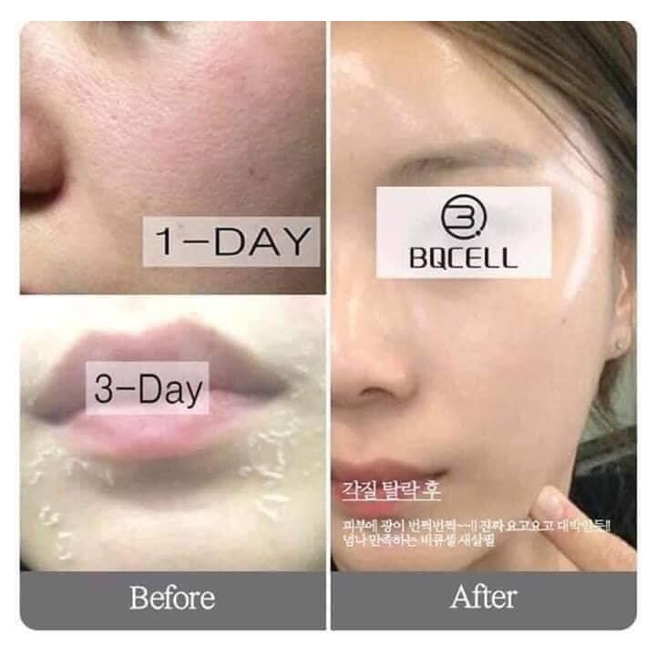 [BQ Cell] Peel Da Hàn Quốc Hỗ Trợ Giảm Thâm Mụn, Đẹp Da