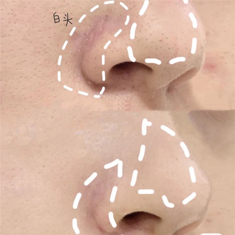 [Hàng mới về] Thỏi cầm tay loại bỏ mụn đầu đen tinh chất trà xanh ABPOPA QISE | BigBuy360 - bigbuy360.vn