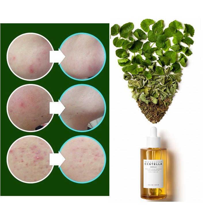 Combo Giảm Mụn Và Dưỡng Da Chiết Xuất Rau Má Skin1004 Madagascar Centella Asiatica( Serum 100ml + Ceam 75ml )