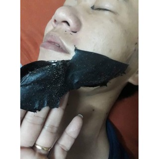 Lột mụn Than Tre