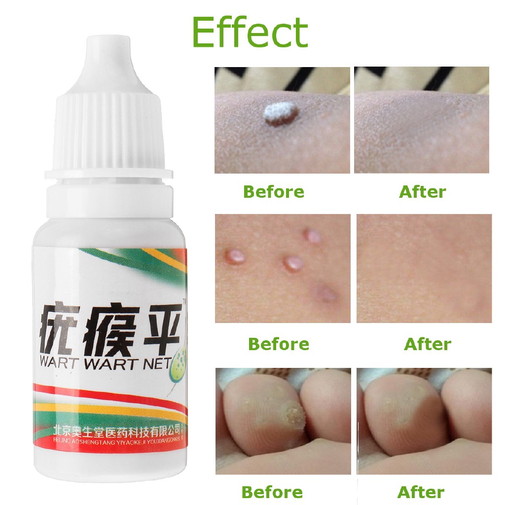 PL◇100% All Natural Skin Tag Remover 10ml - NEW ARRIVAL