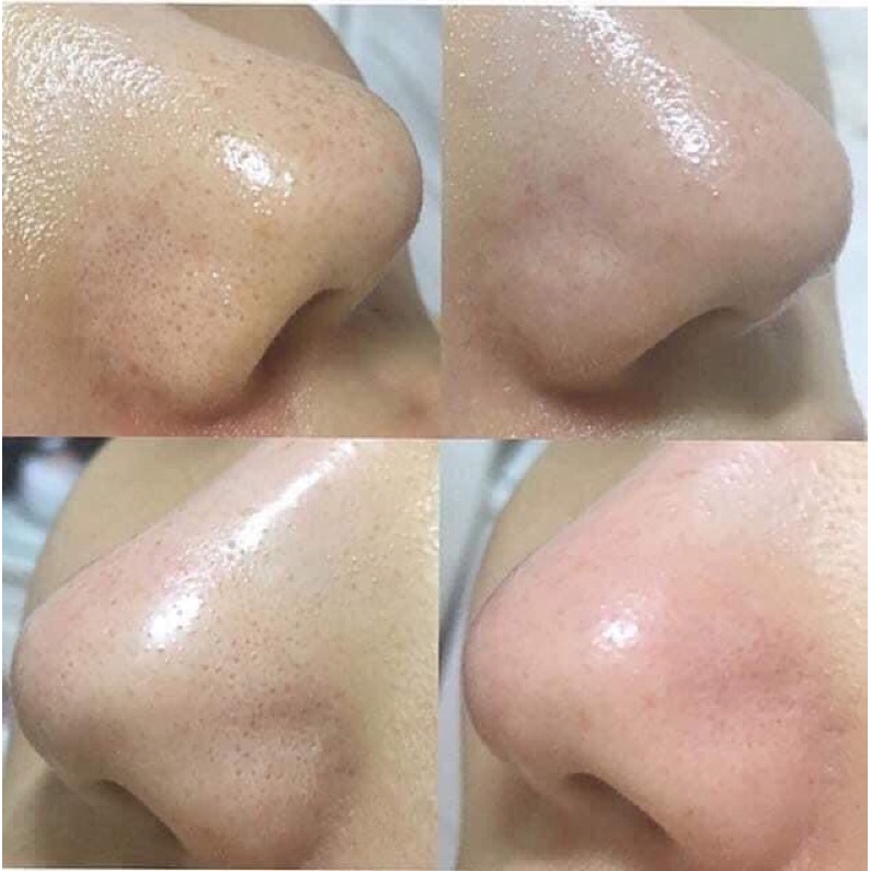 Dùng dịch ủ mụn MEDIPEEL | BigBuy360 - bigbuy360.vn