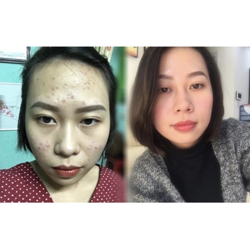 TRẮNG DA GLUTATHIONE 1000 MỚI VIÊN UỐNG ĐẸP DA GIẢM NÁM NÂNG TÔNG TỨC THÌ