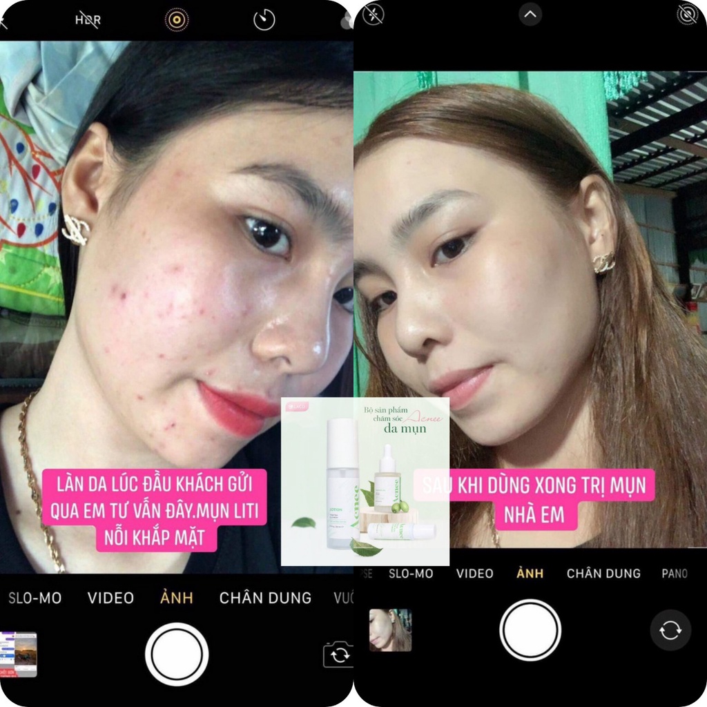 Gel Dưỡng Da Mụn Laco [kem PBH 10 triệu đồng] | BigBuy360 - bigbuy360.vn