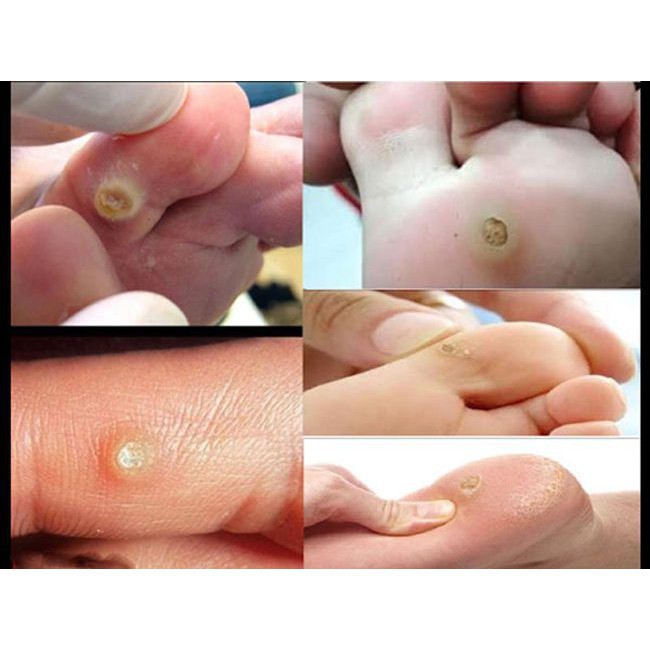 Miếng dán mụn cóc PLASTER, sản phẩm dành cho người bị mụn cóc, mụn mắt các chân, dễ sử dụng và không tái phát | BigBuy360 - bigbuy360.vn