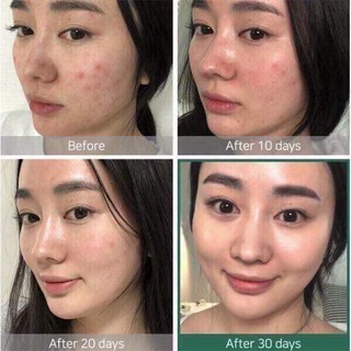Nước hoa hồng tái tạo làn da AHA-BHA-PHA 30Days Miracle Toner